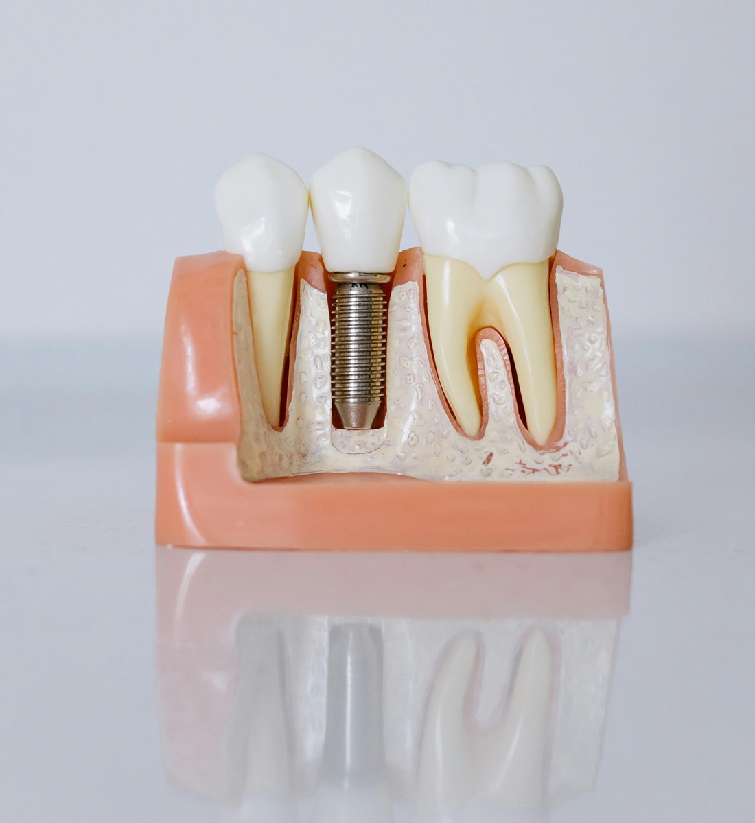Implantes dentales en Madrid — Amaro Odontología